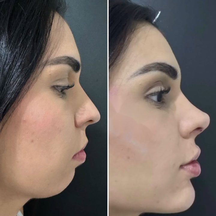 Antes e depois – Protocolo IArmonize Full Face